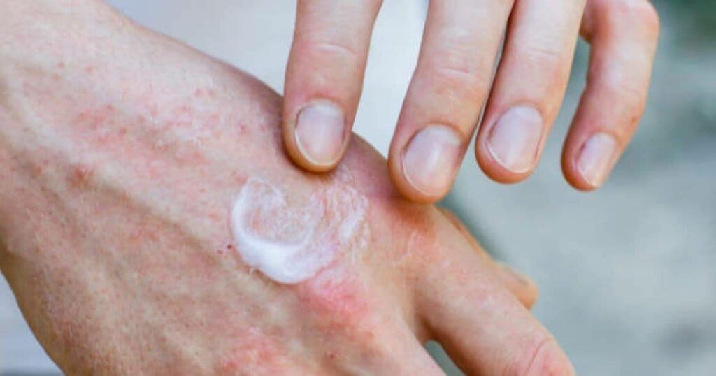 Stresul crește inflamația pielii: Cum agravează eczemele