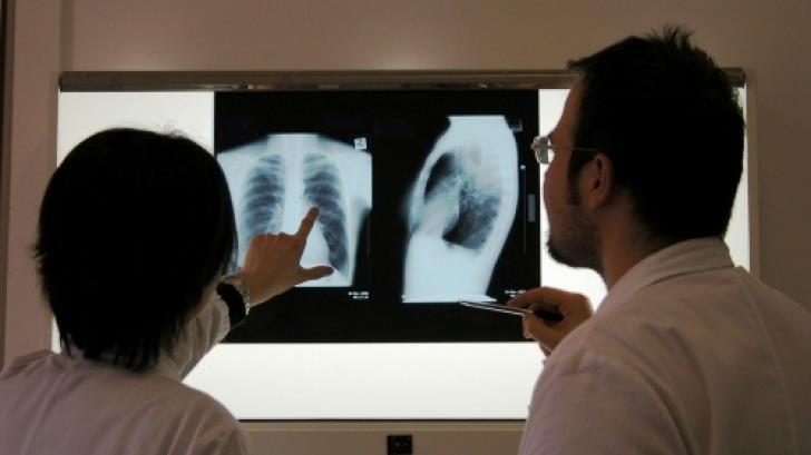 România, lider în UE la cazuri de Tuberculoză, în Ziua Mondială de luptă împotriva bolii
