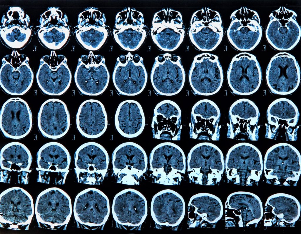 Un milion de români suferă de boli neurologice rare, inclusiv epilepsie