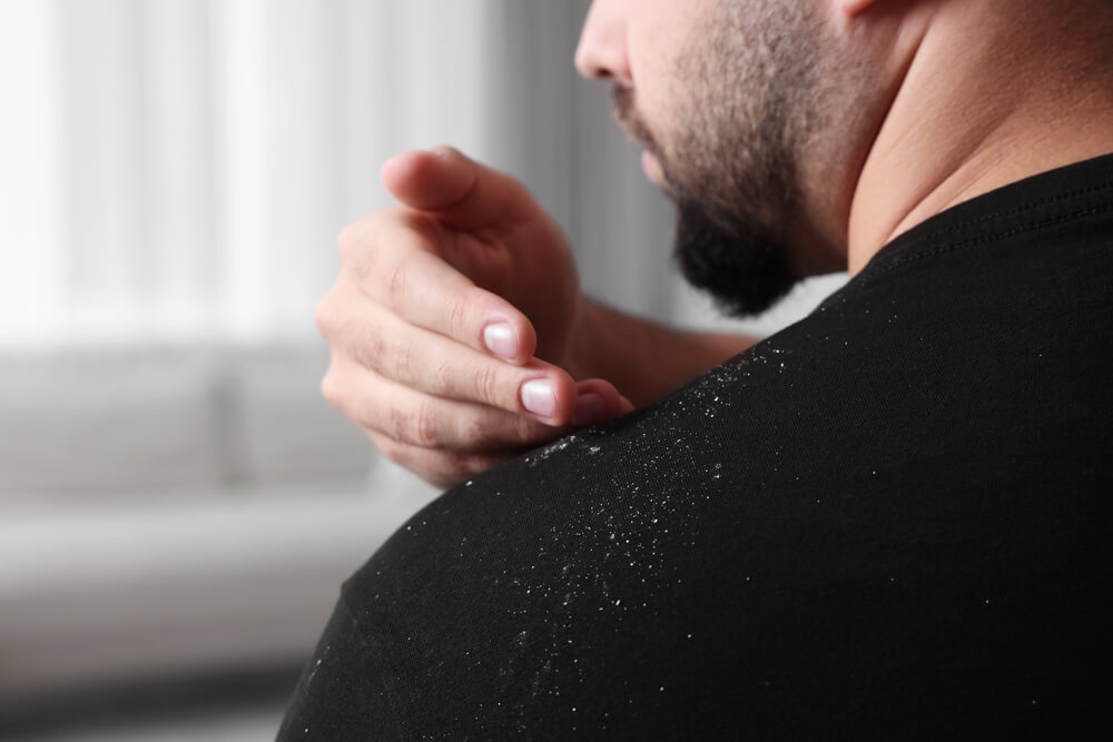 Șampon antimătreață: ingredientele active care funcționează