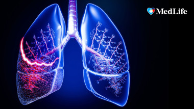 Tusea persistentă: când e semn al bolilor pulmonare grave