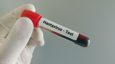 Tânăr din Arad confirmat pozitiv cu hantavirus. Detalii de la autorități.