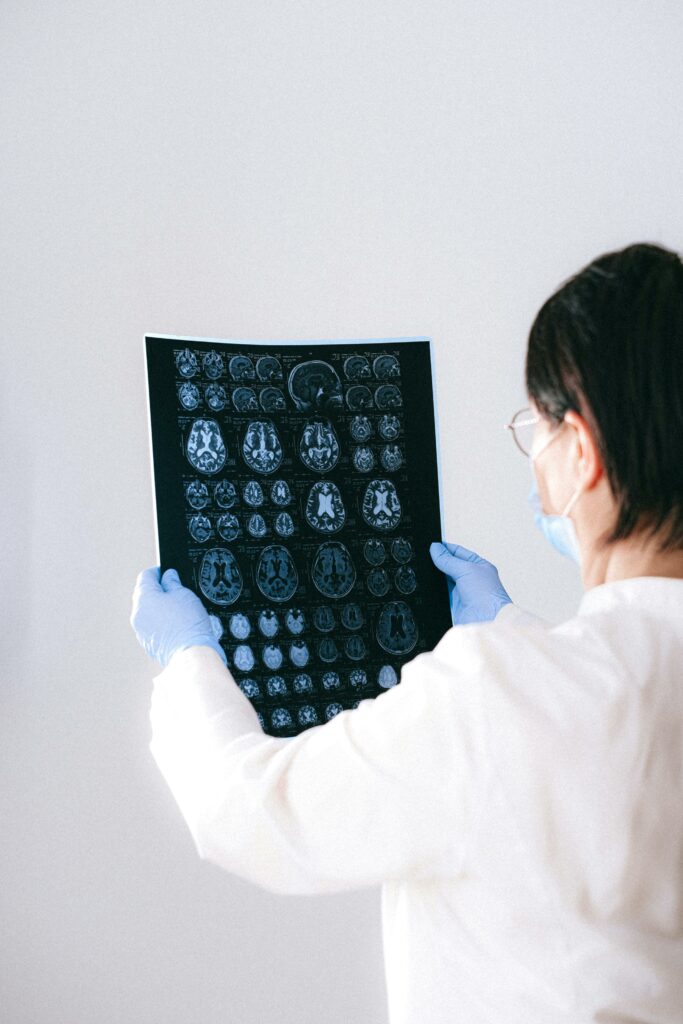 Nou tratament pentru epilepsie: descoperire promițătoare