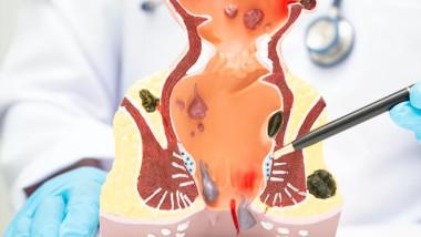 Robotica în chirurgie salvează o femeie cu cancer rectal metastatic